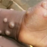 SLM Authorities Warn of Rising Monkeypox Cases in Jebel Marra