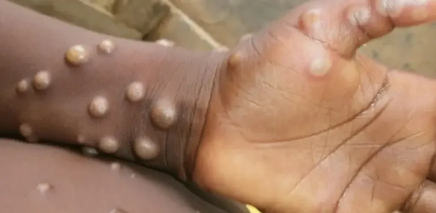 SLM Authorities Warn of Rising Monkeypox Cases in Jebel Marra